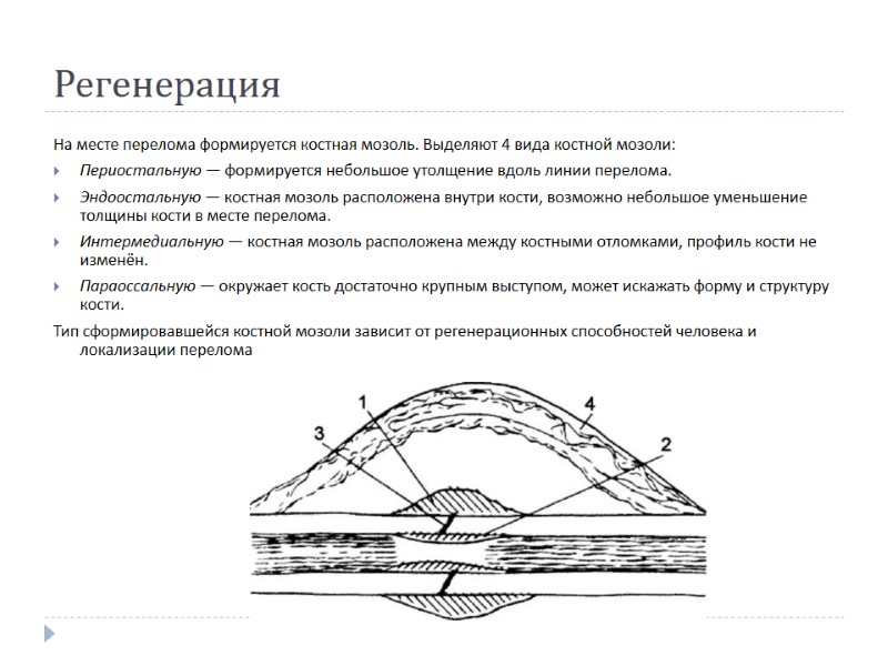 Регенерация На месте перелома формируется костная мозоль. Выделяют 4 вида костной мозоли: Периостальную —